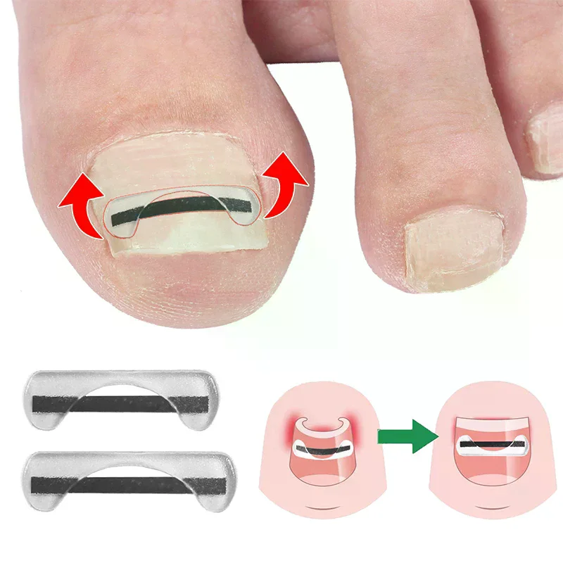 Fil de Correction des ongles incarnés en alliage de titane, dispositif de traitement des ongles, autocollants, outil en Silicone, accessoires de soins des pieds, usage quotidien