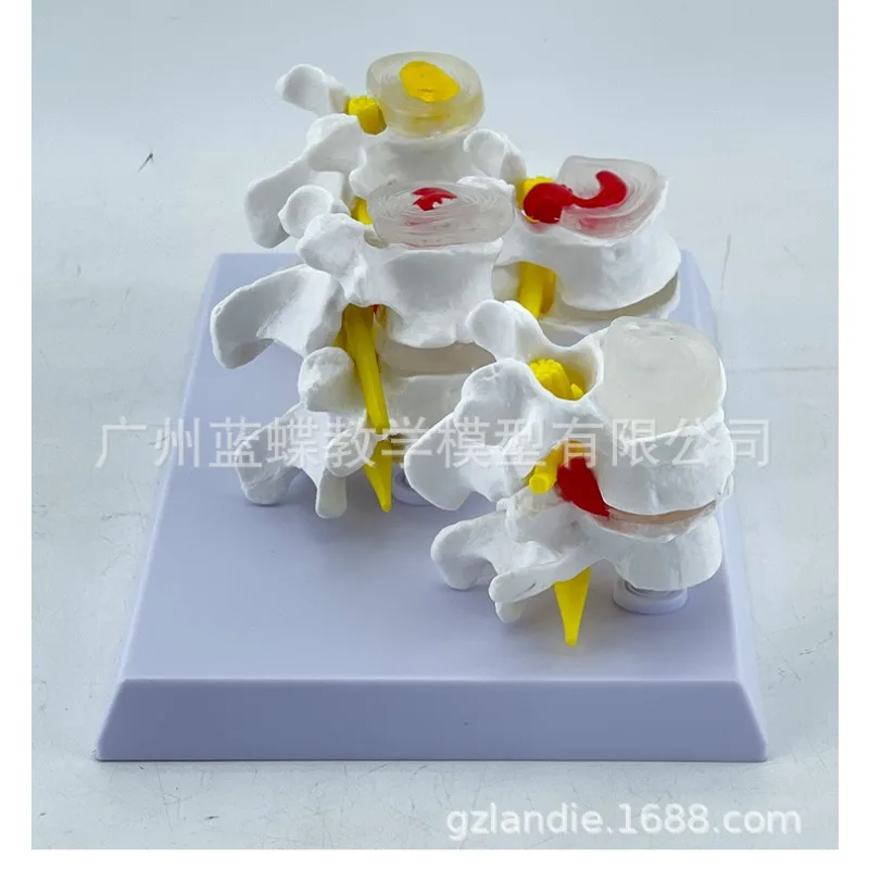 Skeleton Anatomical 4-stage Osteoporosis Vertebrae Anatomical Model Nursing Model Skin In Trauma Lumbar Degeneration Model