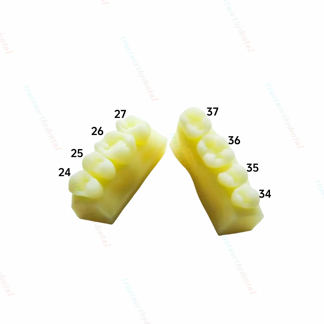 Modèle de caries dentaires, modèle de carie dentaire, modèle de restauration composite, molaire antérieure, 3 ensembles