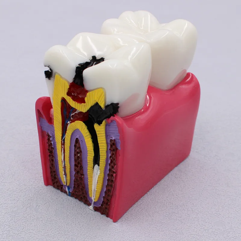 Modelo dental dos dentes do laboratório para o dentista, materiais do estudo para estudar e pesquisar, 6 vezes cárie, 1PC