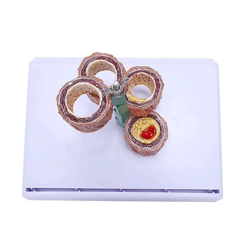 

2X модель атеросклероза, тромбоза, демонстрация сосудистых заболеваний, модель сосудистой патологии сердца