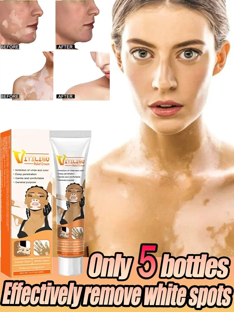 Vitiligo Ointment Herbal Extract Remove Ringworm White Spot Removal Skin Vitiligo Eliminate Vitiligo Treatment Cream