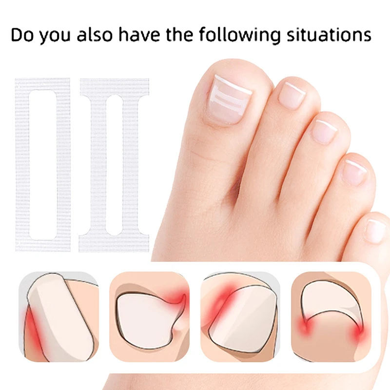 10 pcs Alien Ingrown Toenail Corrective Clip Strips Nail Treatment Elastic Corrective Clip Bracket Foot Care Tools