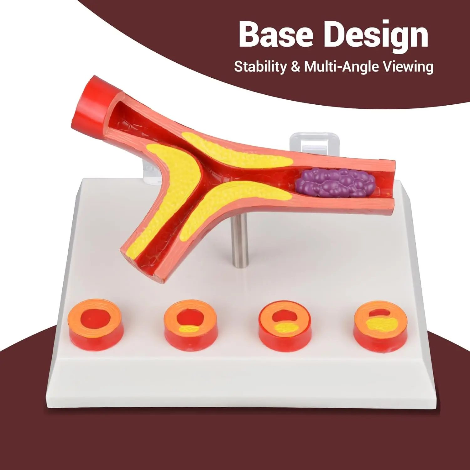 Human Atherosclerosis Cardiovascular Model Vascular Disease Blood Vessel Anatomy Model for Medic Education Health Demonstration