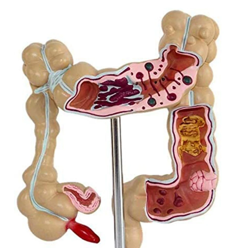 Imagem -06 - Modelo do Intestino Grande Patológico do Cólon Câncer Colectal Anatômico Gastroinário