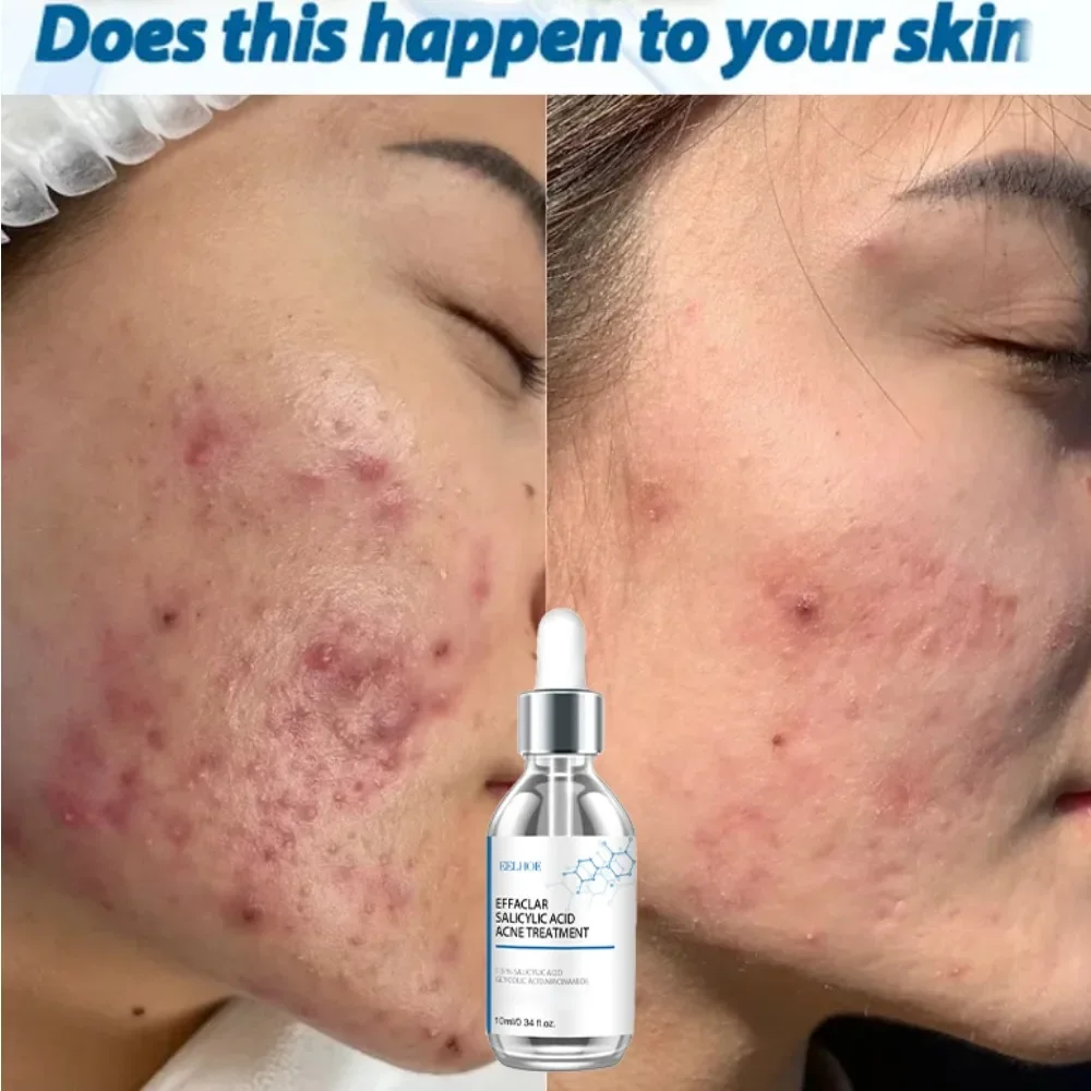 

sell wellAcne products, professional formula, soothe acne, restore healthy skin shine. Cream