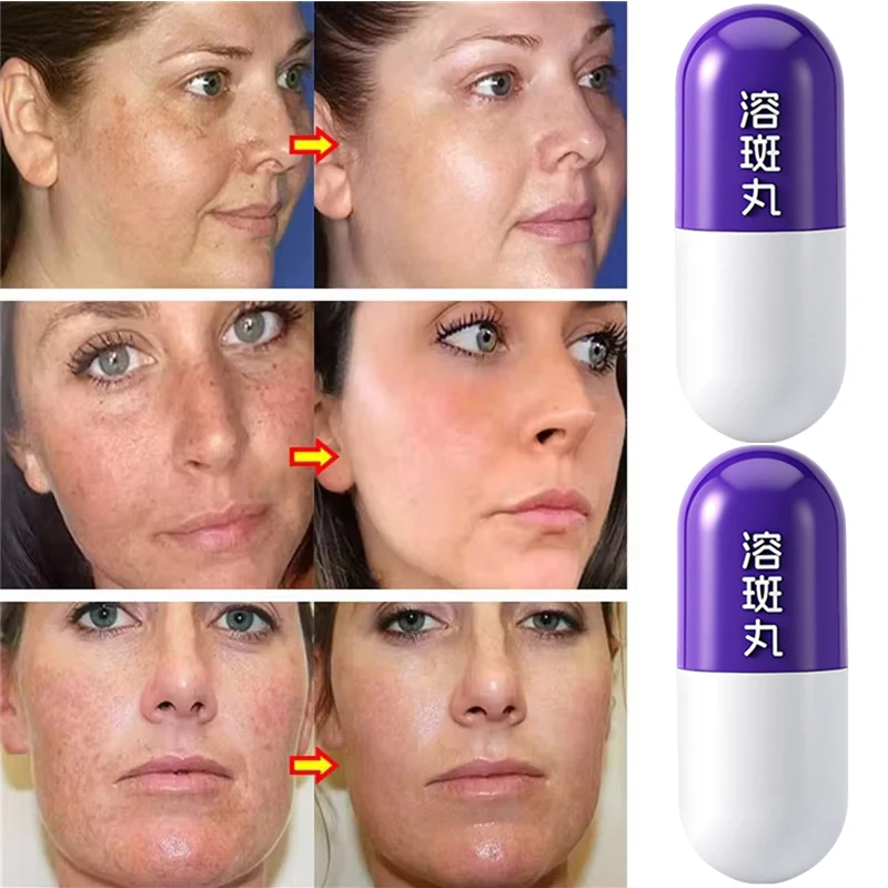 فعال تبييض النمش إزالة أكوا جوهر 377 بقعة حبوب تذويب إزالة الكلف تتلاشى التصبغ سطع العناية بالبشرة #2