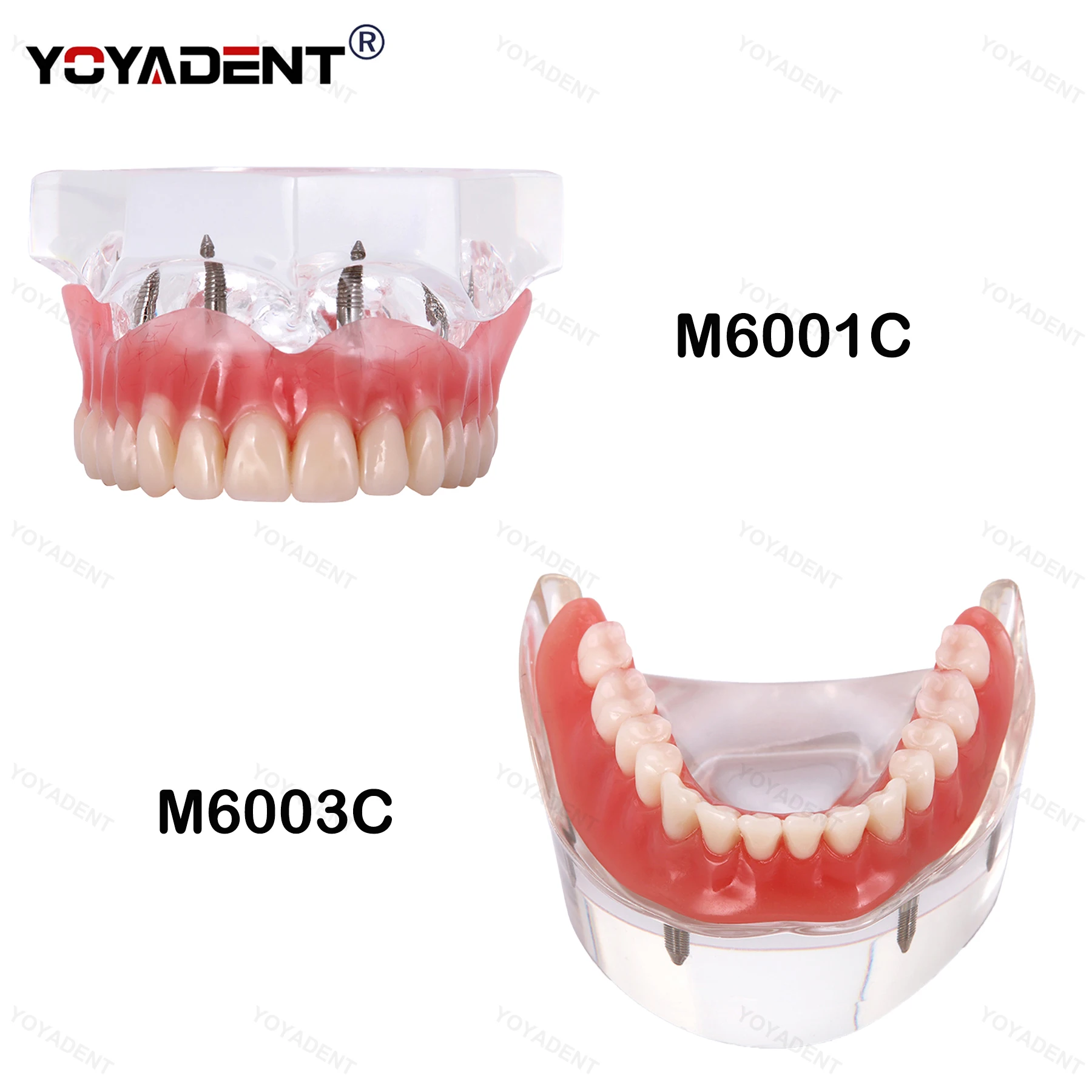 

Dental Teeth Model With 4 Implants Overdenture Restoration Model Clear Upper Lower For Dentist Patient Communication Demo