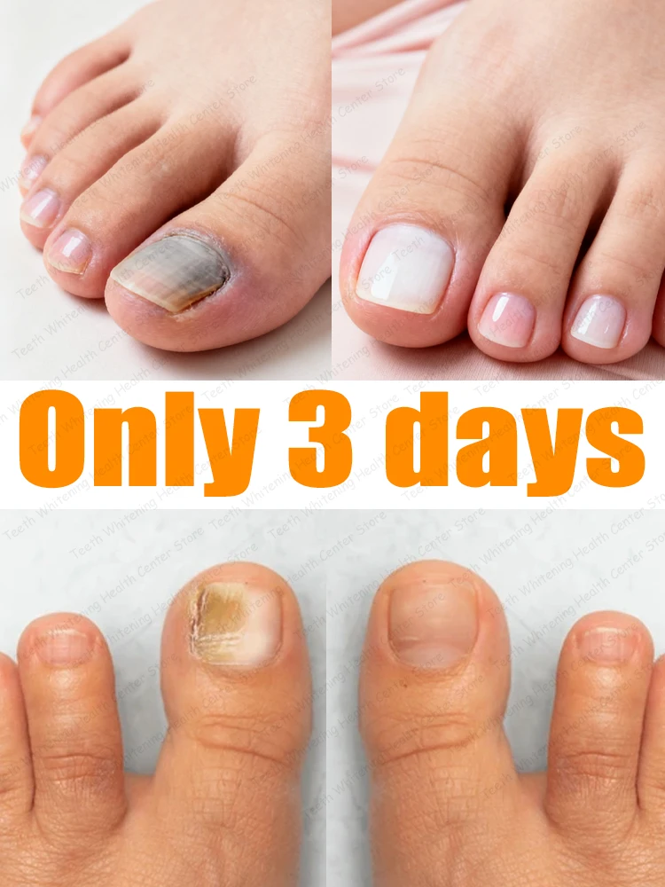 

ᴮˡᵘᵉ ˡⁱᵍʰᵗ ˡᵃˢᵉʳ ᵗʳᵉᵃᵗᵐᵉⁿᵗ ᵖᵉⁿ for ᵗʳᵉᵃᵗⁱⁿᵍ ᵒⁿʸᶜʰᵒᵐʸᶜᵒˢⁱˢone button operation