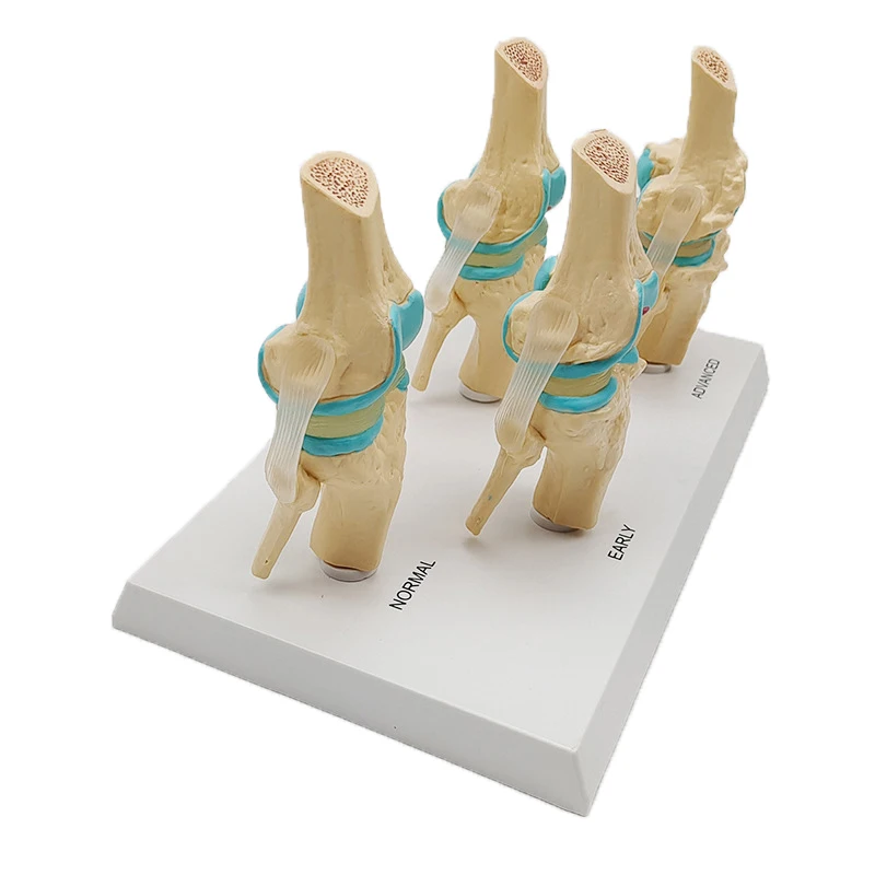 Four-stage Human Pathological Knee Joint Anatomy Model Medical Science Teaching Resources Dropshipping