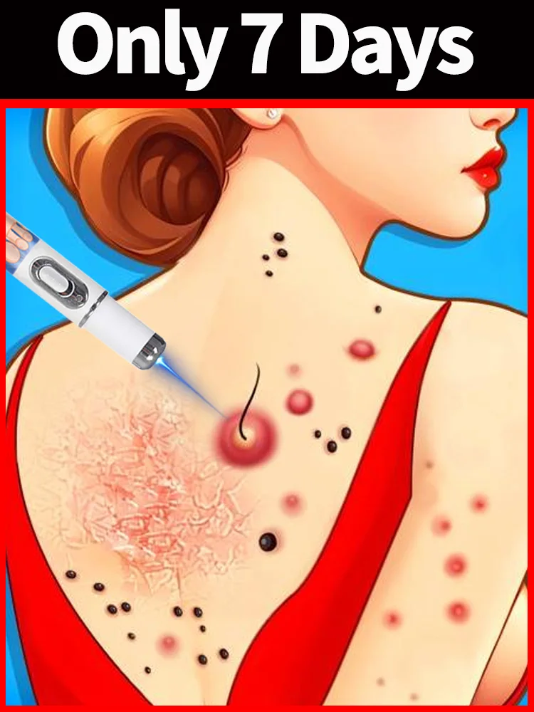 

Generation-2 Laser Says Goodbye To Wart Remove Quickly