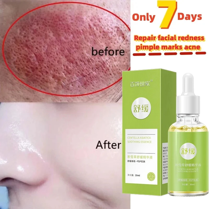 7 Day Repair Redness Serum Sooth Itching Sensitive Skin Improve Rosacea Shrink Pore Smooth Nourish Facial Skin Korean Cosmetics