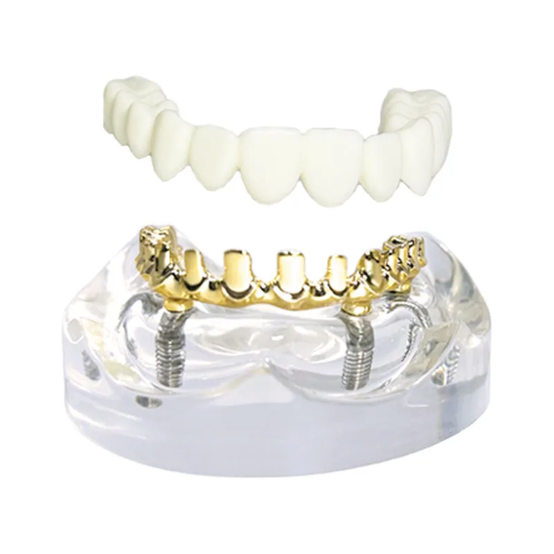 Dental Model Implant Restoration Model Maxillary Removable Overdenture over-restored teeth Model Dental Oral Teaching Research