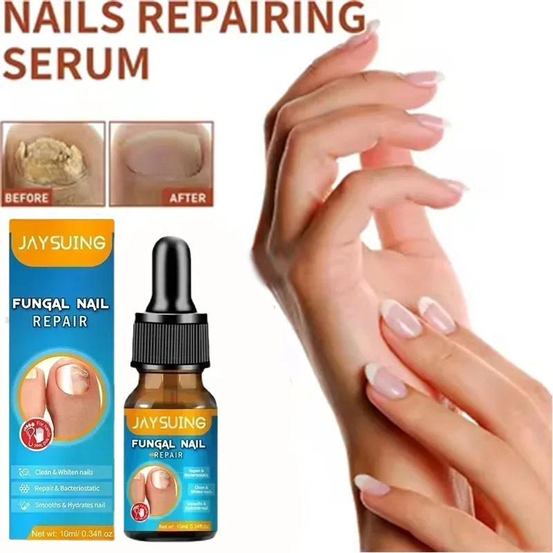 New Nail Fungus Treatment For Toenail Strength Repair Solution Hydrates Renew Damaged Discolored Foot