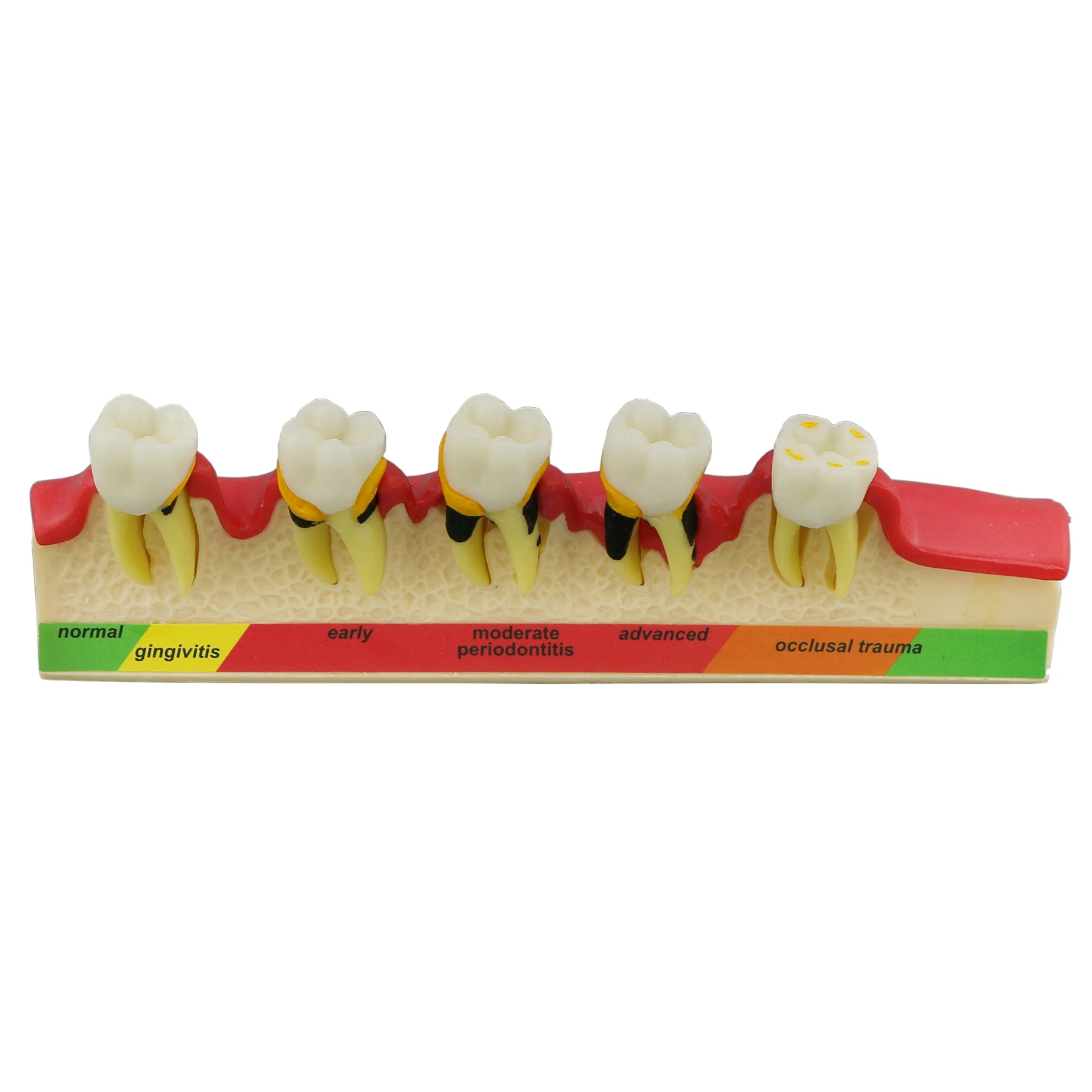 Dental Models Demonstrates Periodontal Disease Pathological 5 Stages Progress For Teaching Education Demo