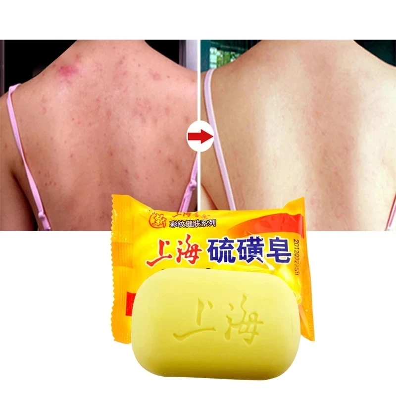 6PCS Shanghai Sulfur Soap Oil-Control Acne Treatment Psoriasis Seborrhea Eczema Anti Fungus Perfume Butter Bubble Bath 85g