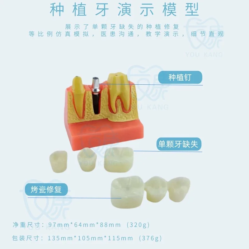 Dental Implant 4x Implant Solution Model, Denture Restoration Dental Implant Interpretation, Removable, Bridge Crown