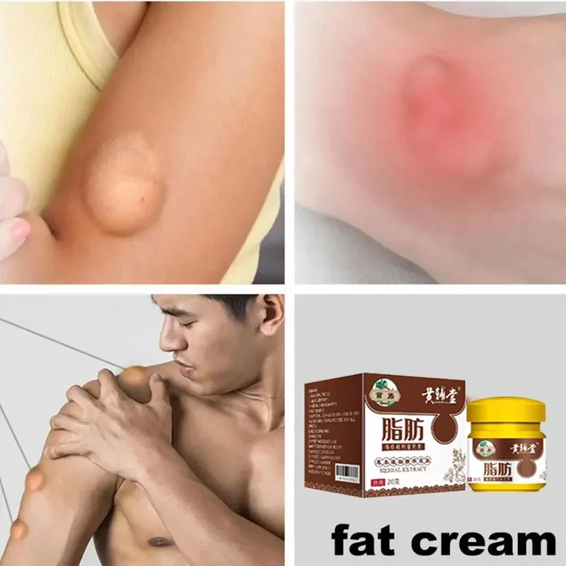 Lipoma Removal Cream Body Cream Dissolving Fat Easy To Use Lipoma Removal Cream