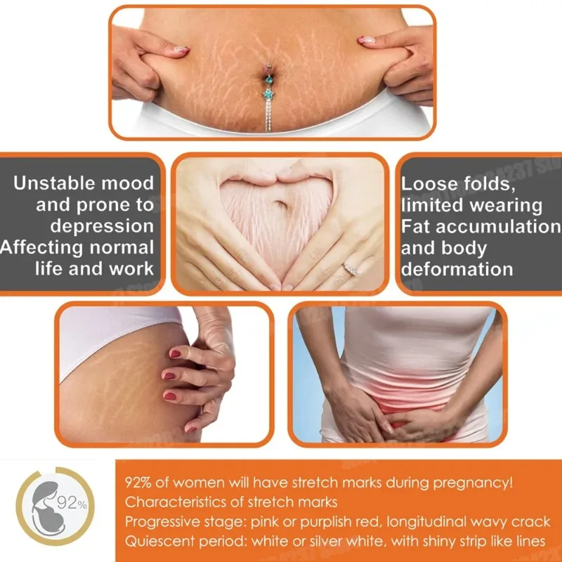 

Stretch Mark Removal Cream Permanently Removes Stretch Marks Rejuvenates Skin Stretch Mark Removal Cream