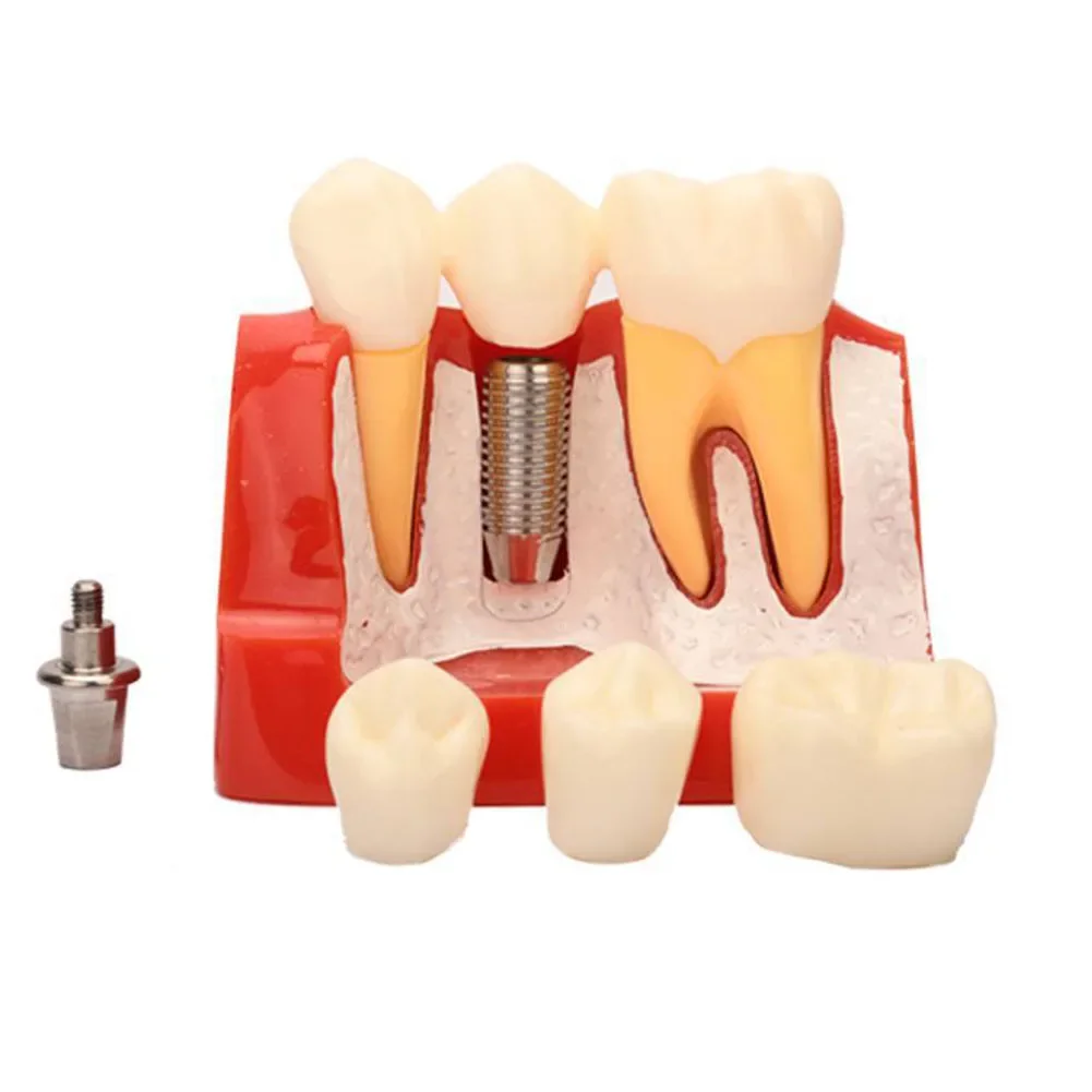 

4 Times Dental Teaching Model Implant Analysis Crown Bridge Demonstration Denture Mold Set Dentist Removable Resin False Teeth