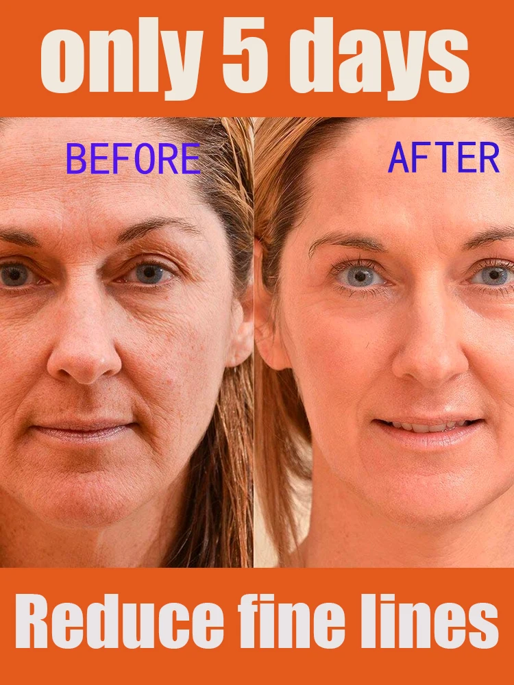 

Нет видимых сухих линий, что придает пухлый вид.