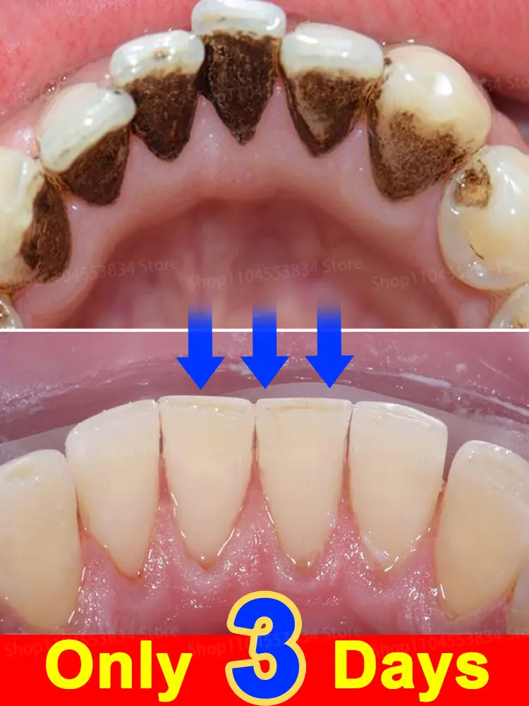 

Cleaning Teeth Smoke Coffee Tea Stain Reduce Oral Odor Brightening Tooth