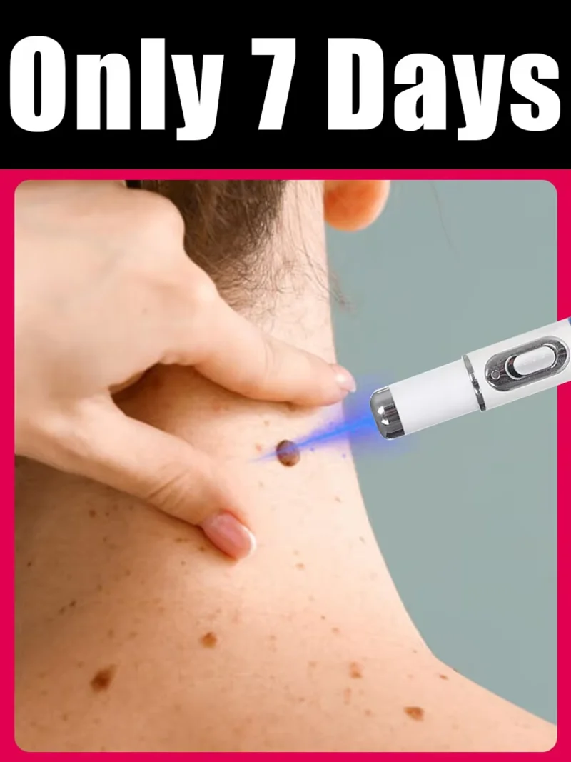 

Новинка 2026: Устройство для удаления бородавок синим светом, хит продаж, инструменты для ухода за кожей