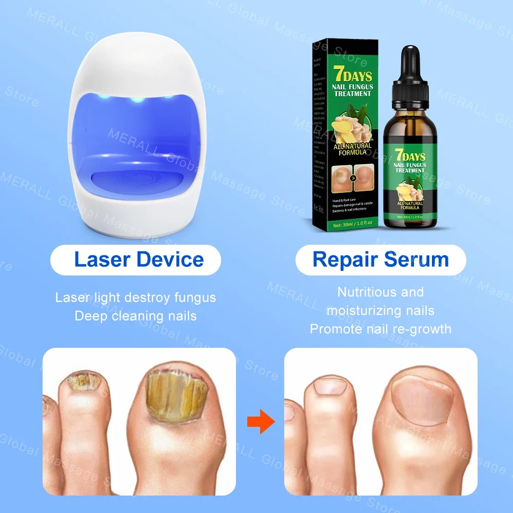 Nail Fungus Laser Device Nail Fungal Treatment Essential Oil Repair Toenail Fingernail Anti Infection Onychomycosis Cure Ingrown