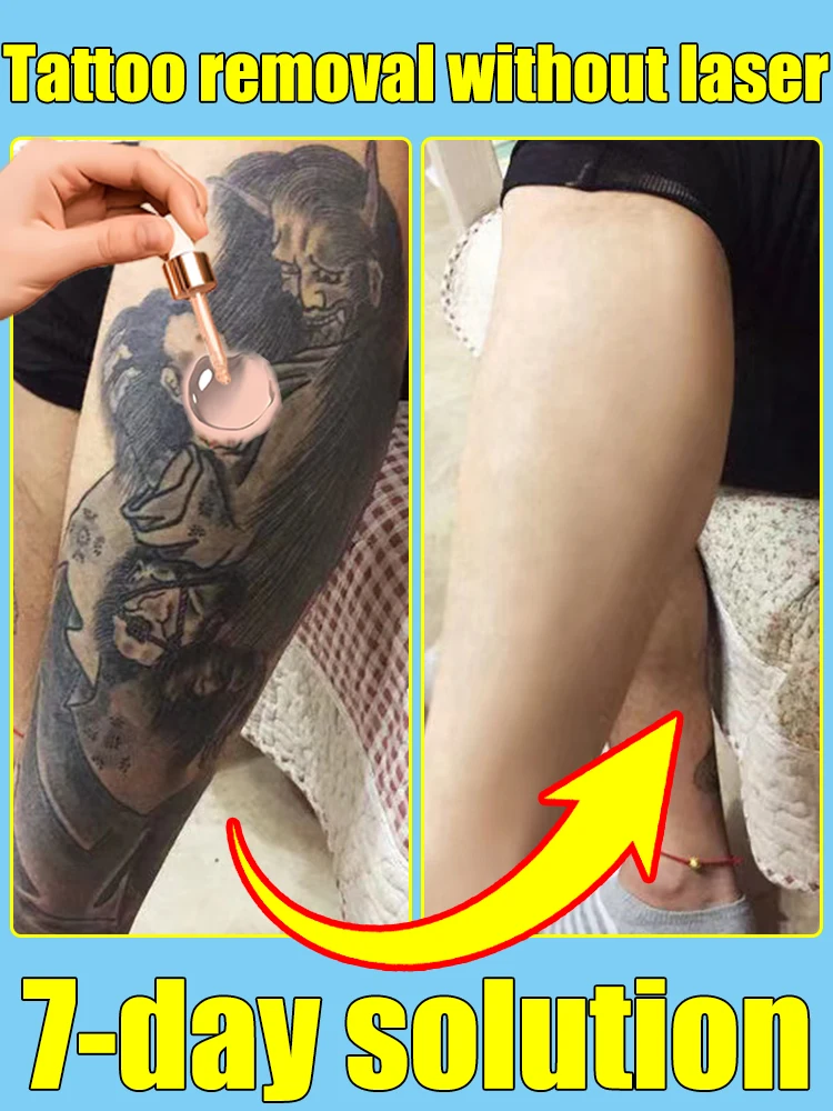 Tattoo-Entfernungsspray, pigmentiertes Permanent-Make-up, Tattoo-Entfernung