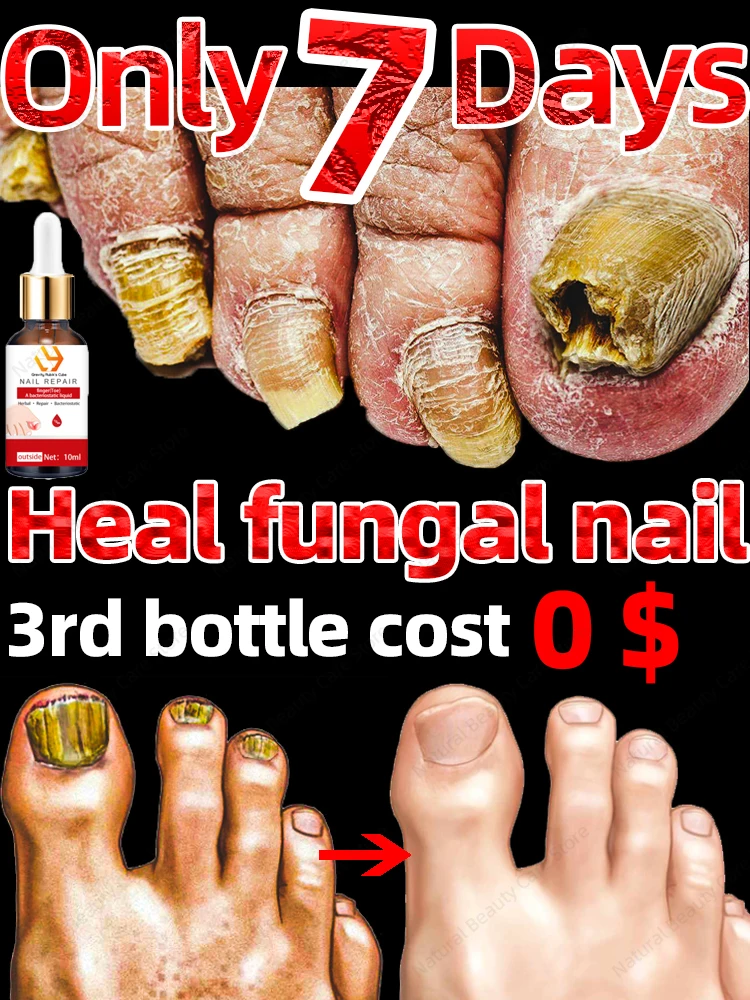 

Fungus Nails Fungal Nail Repair Fast