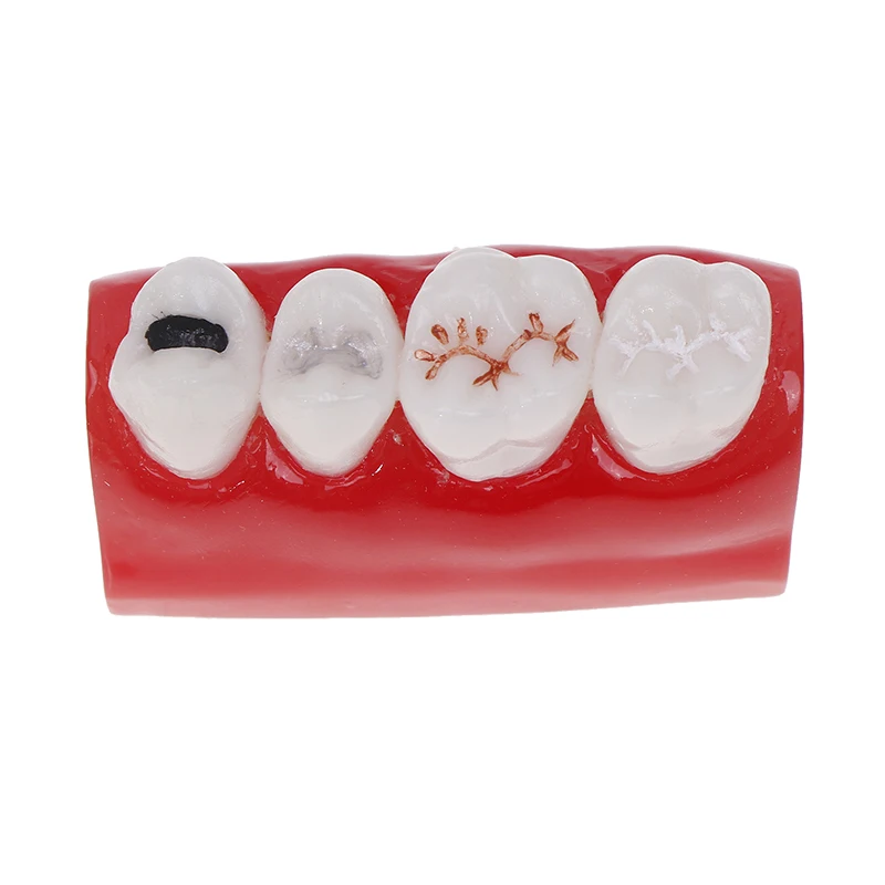 

Dental Resources Sealants Demonstration Dental Study Model Dental Pit And Fissure Closed Model Treatment Teeth Model