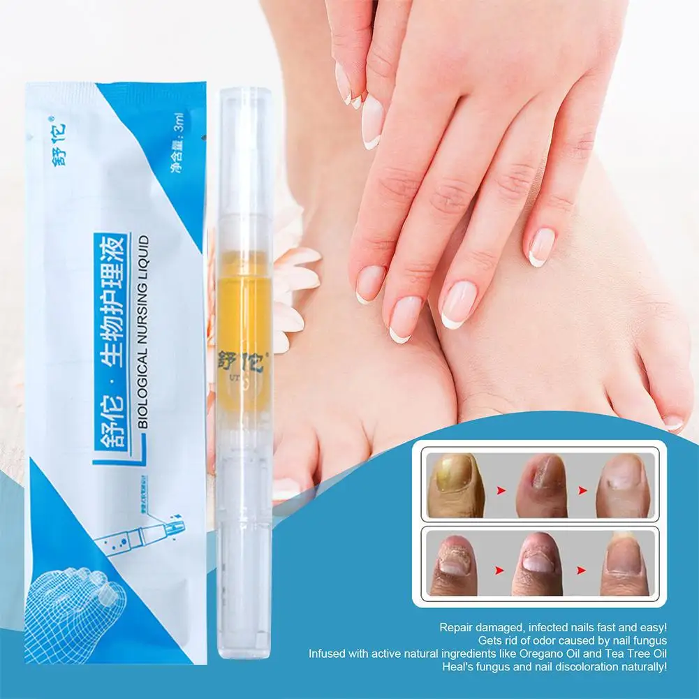 Nail Fungal Repair Liquid Pen Onychomycosis Paronychia Hand Toe Nail Fungus Infection Repair Fungus Serum Gel Anti Removal V5c1