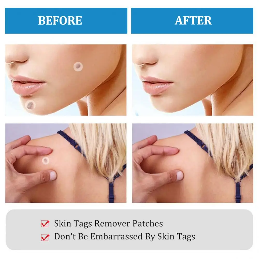 2In1 Painless Auto Skin Tag Mole Wart Removal Kit Face Skin Care Body Wart And Dot Treatments Remover Plantar Warts Corn Removal