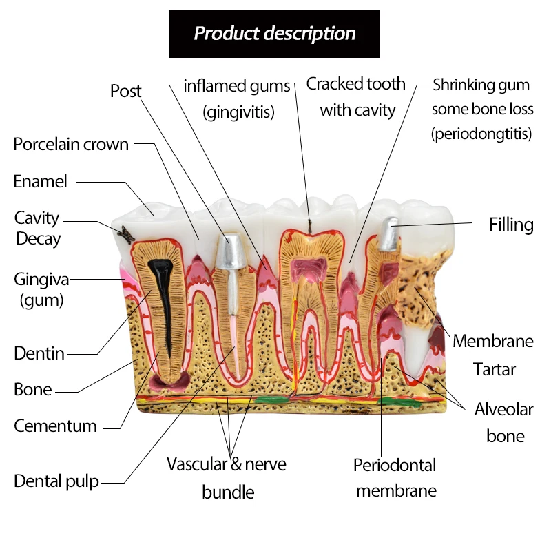 Model anatomiczny próchnicy dentystycznej Kompleksowy model zębów z nerwem patologii do nauczania jamy ustnej Model zębów