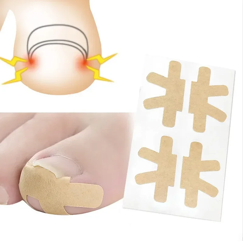 3Set Toenail Corrector Nail Strip Anti-roll Nail Free Glue Toe Inlay Nail Corrector Ingrown Patch Correction Toenail Stickers