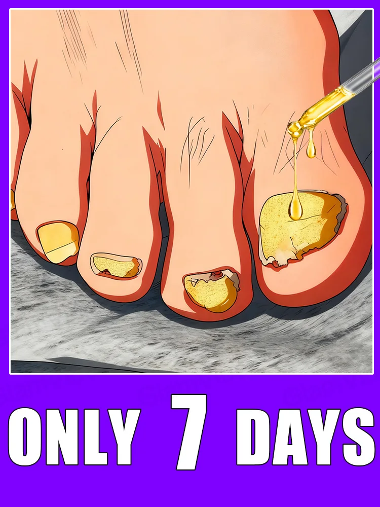 

Qᴜɪᴄᴋ Tʀᴇᴀᴛᴍᴇɴᴛ, Sᴀʏ Gᴏᴏᴅʙʏᴇ ᴛᴏ Fᴜɴɢᴀʟ Nᴀɪʟ Wᴏʀʀɪᴇs