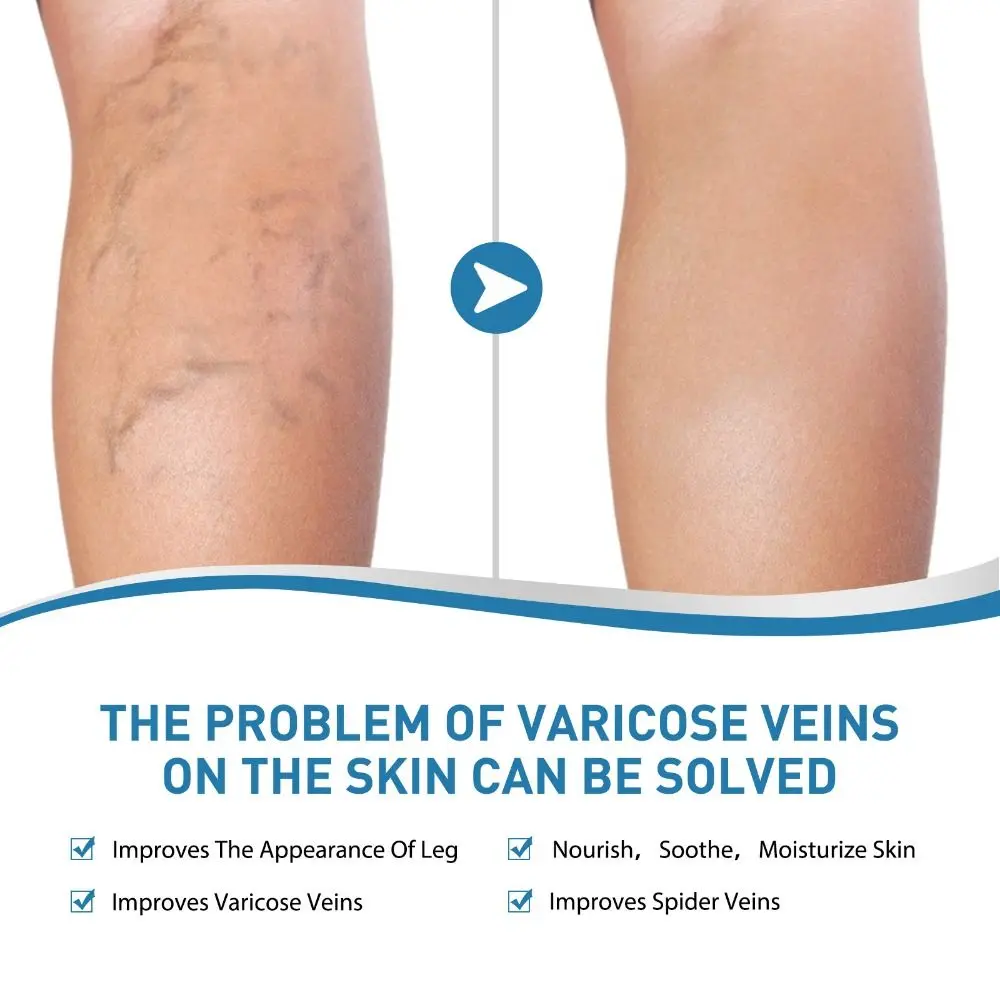 2PCS Soothes Tired Varicose Veins Treatment Cream Reduce Leg Swelling Fast-Acting Wellness Cream Improve Blood Circulation