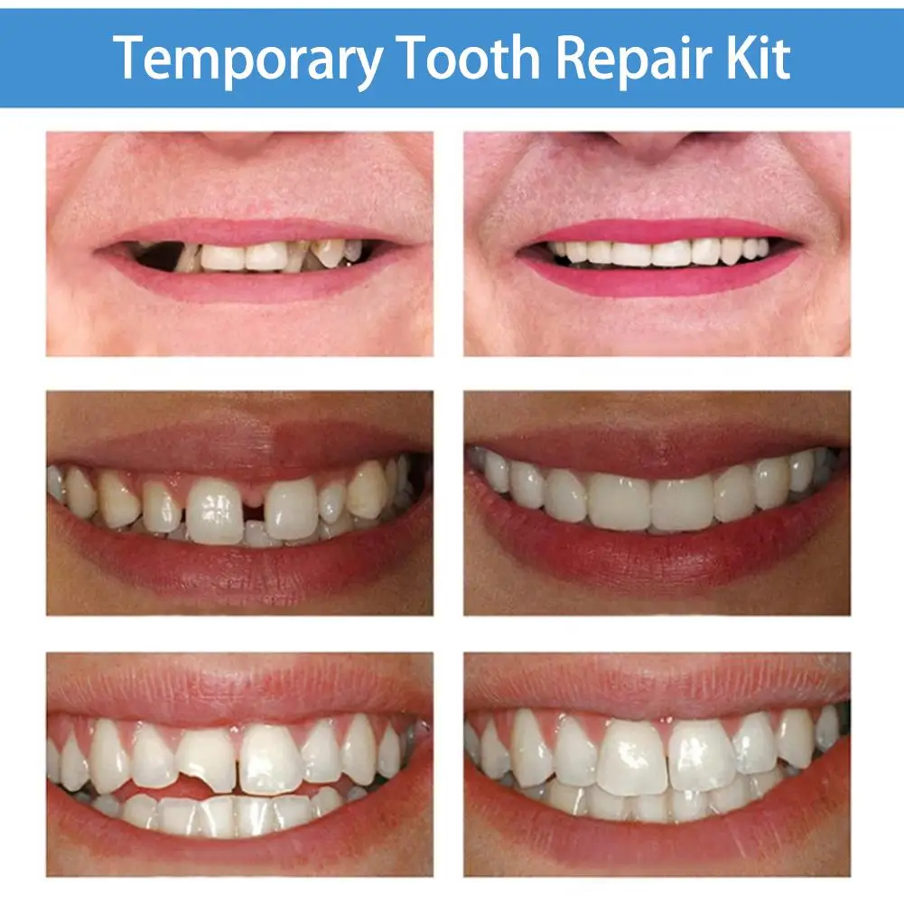 5g/10/15/20g Temporary Tooth Repair Kit Resin Teeth Gaps Filling Shapeable Glue Denture Adhesive Dental Beauty Supplies