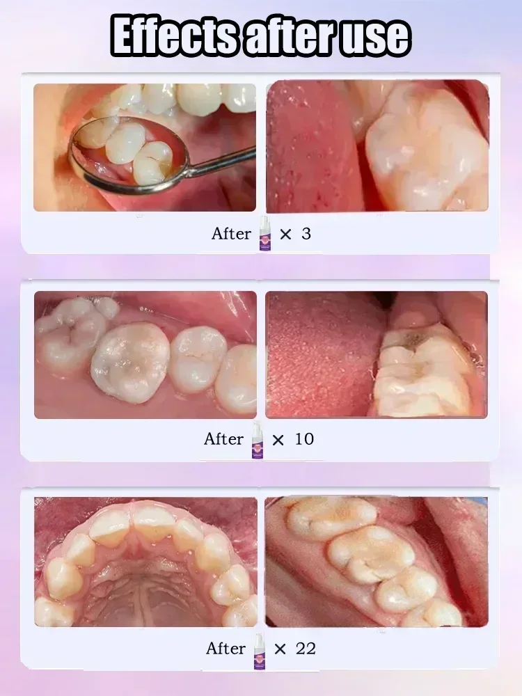 Toothpaste of Teeth Whitening Repair of Cavities Caries Removal of Plaque Stains Decay Repair Teeth Treating Dental Calculus