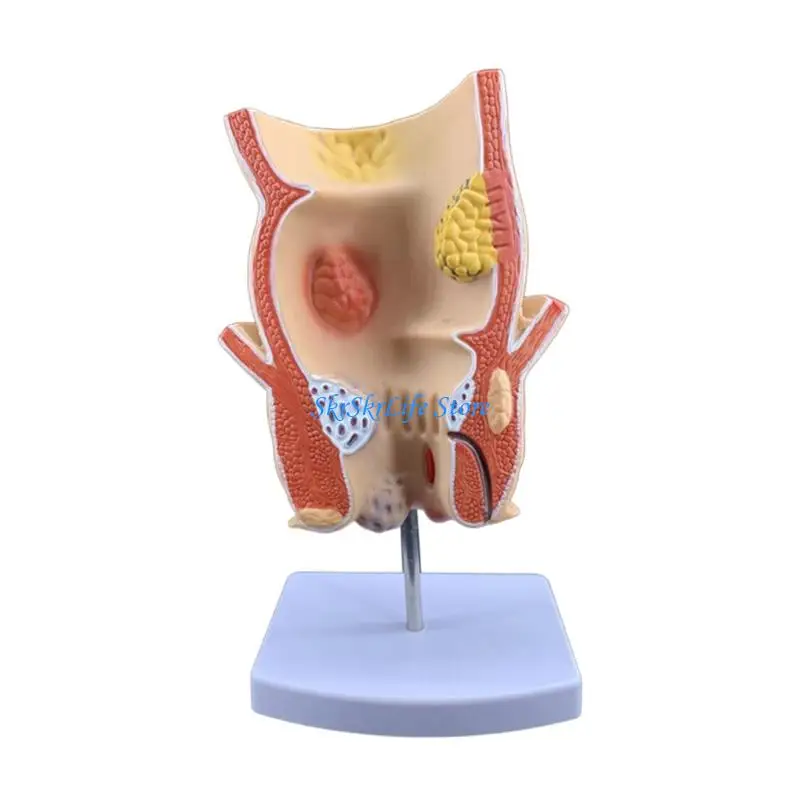 E65E Anatomy Demonstration Model for Pathology Study, 3D Sectional PVC Teaching Aid for Class Display and Learning Reference