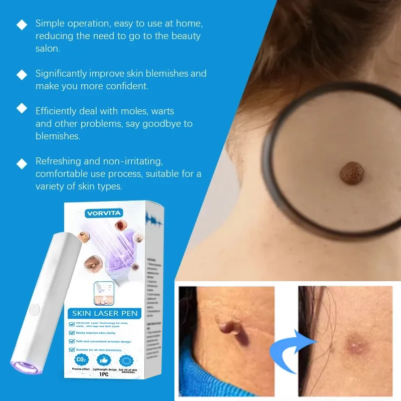 사마귀 제거 도구 레이저 펜 스킨 케어 펜, 바디, 얼굴, 피부, 현장 청소, 특히 가볍고 휴대용 홈 디자인