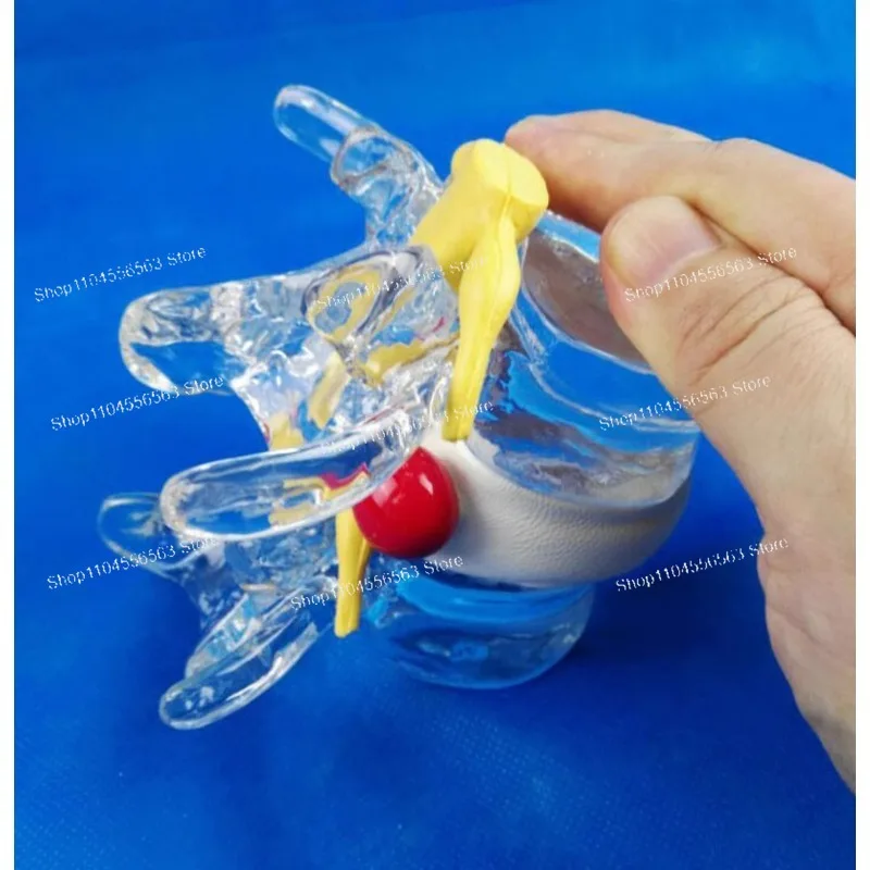 

Spine and spinal cord extrusion disc herniation, lumbar disc demonstration model, lumbar spine model new product