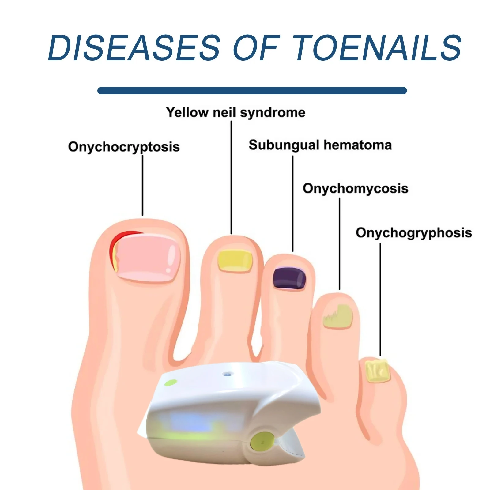 

Nail Fungus Laser Device, Portable Toenail Fungus Treatment for Men and Women, Onychomycosis Repair System