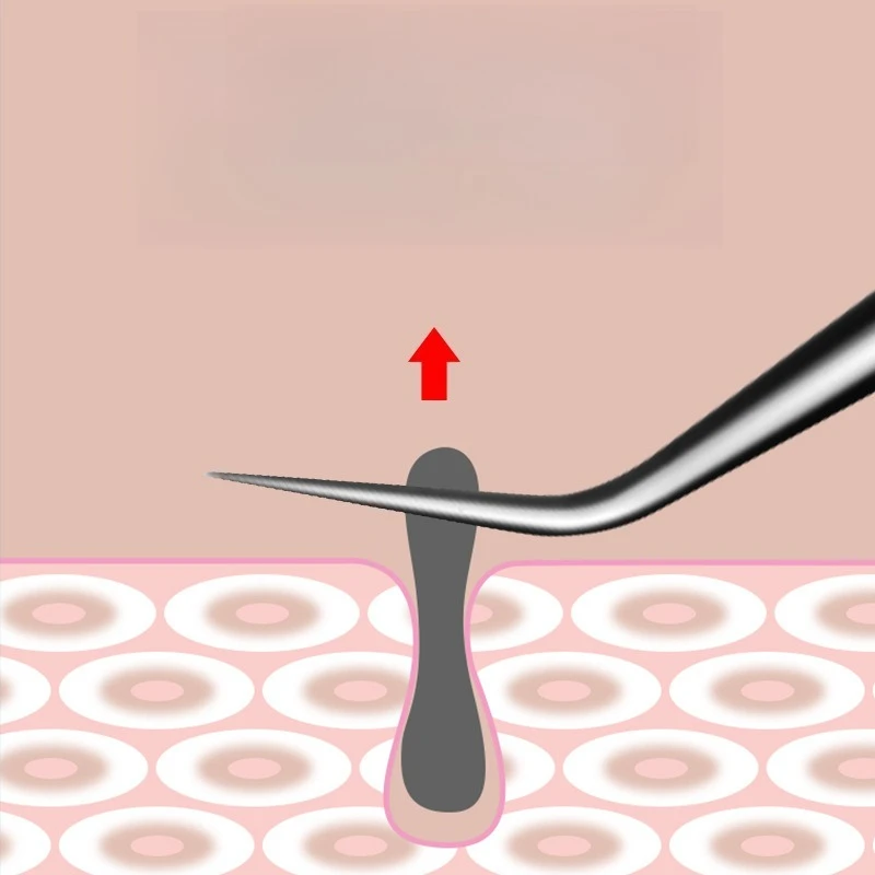 Rvs Acne Verwijdering Naalden Puistje Comedondrukker Gereedschap Dots Cleaner Pore Cleaner Diepe Reiniging Gezicht Huidverzorging Tool