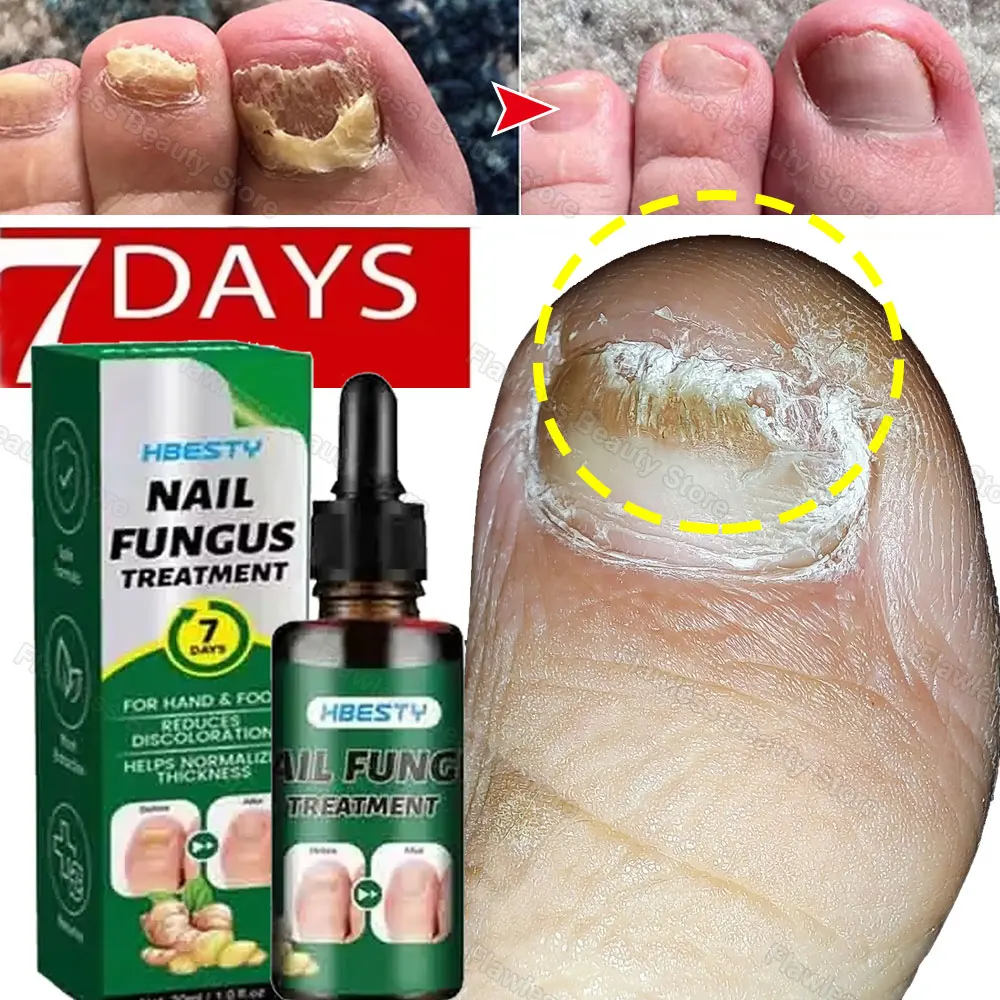 مسمار إزالة الفطريات مصل القدم تو مسمار الفطريات العلاج إصلاح زيت طبيعي مكافحة العدوى فطار الداحس العناية بالأظافر