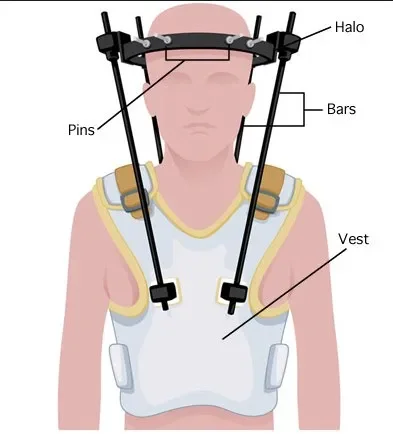 Professional Medical Halo-Vest