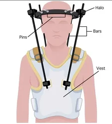 Professional Medical Halo-Vest