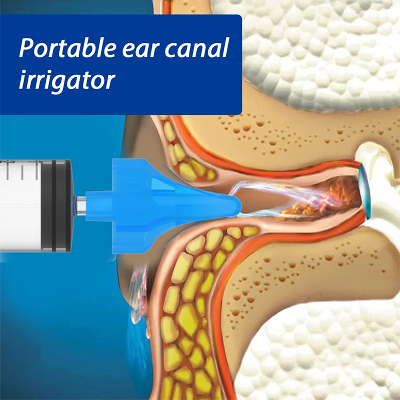 귀 세척 관개 키트, 귀 왁스 제거 도구, 물 세척 주사기