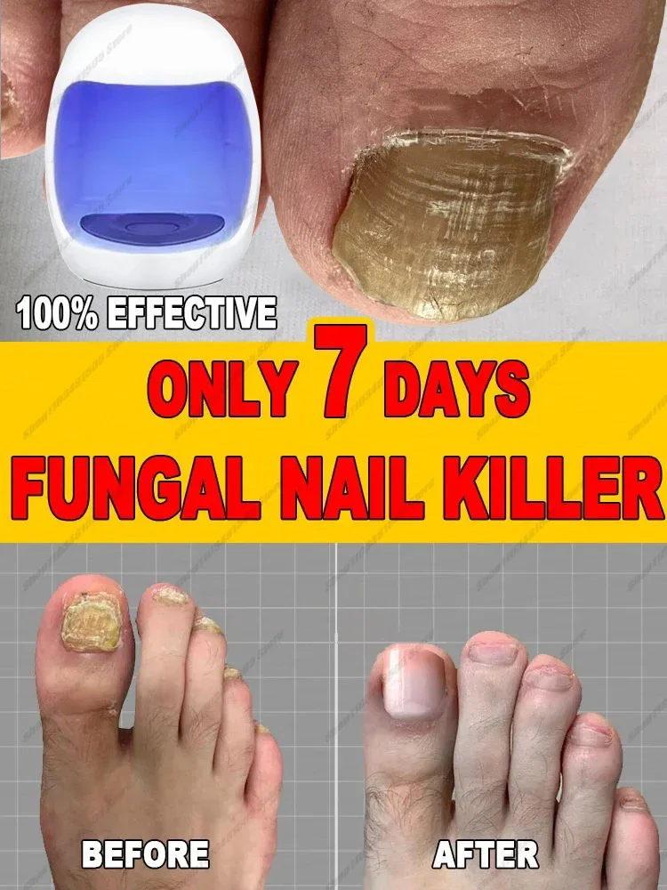 Fungal Nail Laser Onychomycosis Fungus Nails Repair Fast