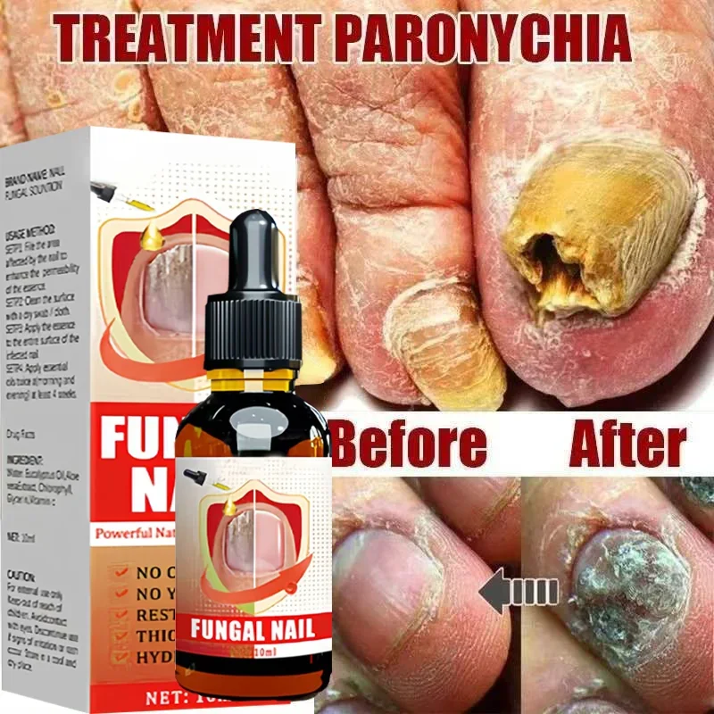 Fungal Nail Treatment Serum Foot Nail Fungus Removal Repair Gel Anti Infection Paronychia Onychomycosis Foot Nails Care Essence